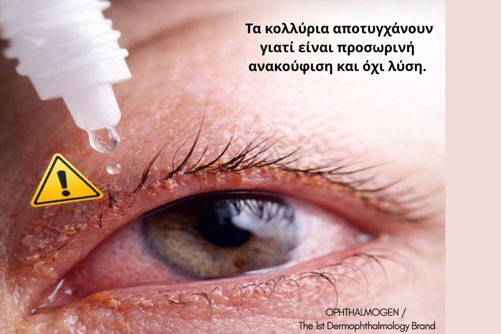 Βλεφαρίτιδα: Γιατί η καθημερινή υγιεινή των βλεφάρων είναι το κλειδί 2 βλεφαρίτιδα 3